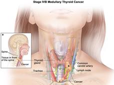 Illustration of Stage IVB Medullary Thyroid Cancer. It shows a detailed view of the neck, highlighting the thyroid gland, trachea, and common carotid artery. An inset on the left depicts a side view of the head and neck, with labels for the the spine and tissue in front of the spine as well as an area labeled "Cancer." The image illustrates how the cancer spreads in the neck region.