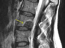 An image of an MRI showing a metastatic tumor in a patient's spine.