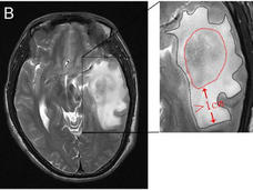 An MRI image of a brain tumor and swelling in the area around it.