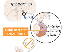 Image of Relugolix effects for advanced prostate cancer