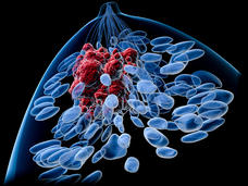 Top view of a female breast with a tumor. Inside of a blue body silhouette, lobules, lactiferous ducts (also blue) and a tumor (in red) can be seen. The background is black.
