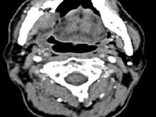Two CT scan images of the neck, labeled "A" on the left. Both images display cross-sectional views with white arrows pointing to specific areas of interest