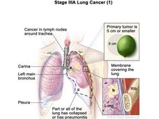 Illustration of Stage IIIA Lung Cancer (1), showing a cross-section of the lungs. Labeled features include cancer in lymph nodes around the trachea, carina, left main bronchus, and pleura. Part of the lung has collapsed or has pneumonitis. Insets show the primary tumor, which is 5 cm or smaller, compared to a lime for size reference, and a close-up of the membrane covering the lung near the rib. 