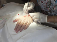 Close-up view of a medical procedure being performed on a person’s hand, showing a healthcare provider using surgical tools while another assists with a cotton swab.