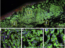 A microscopic image of melanoma cells, highlighting the androgen receptor in cell nuclei. The top panel displays a broad view with green, blue and black areas. Three yellow boxes labeled 1, 2, and 3 indicate areas of interest. The bottom panel provides magnified views of these areas, showing detailed cellular structures.