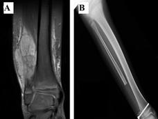 Side-by-side x-ray images. The left image is a close up of a fibula with a large tumor and the x-ray image itself is in shades of dark grey. The right image shows a lower leg with no tumor; the x-ray image is lighter grey and white compared to the left image.