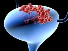 A conceptual image of a bladder in blue and tumors in red.