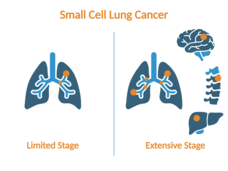 Icons of organs showing that limited stage lung cancer is limited to one side of the lungs while extensive stage lung cancer is in both sides of the lungs and other organs like the brain, bone, and liver.
