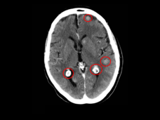 Cross section image of a person's head showing four brain metastases circled in red.