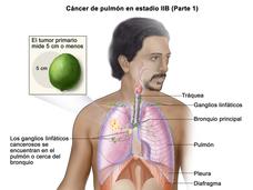 Cáncer de pulmón en estadio IIB. 