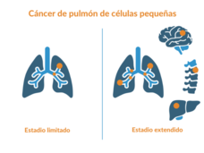 Ilustraciones que muestran que el estadio limitado del cáncer de pulmón se encuentra en un solo pulmón mientras que en el estadio extendido se encuentra en ambos pulmones y en otros órganos como el encéfalo, los huesos y el hígado.