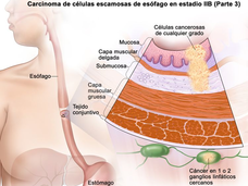 Ilustración anatómica del cáncer de esófago en estadio 2b, con un primer plano de ganglios linfáticos cercanos donde hay cáncer.