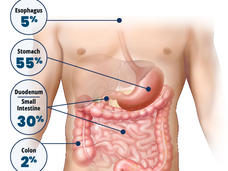 An anatomic illustration showing the different organ sites where and how often GIST develops.