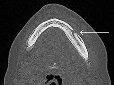 Una tomografía computarizada de una mandíbula con una flecha señalando un área abierta en el hueso.