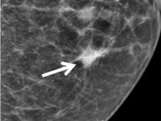 Una mamografía en la que se indica una asimetría focal (tejido más denso) en la mama.