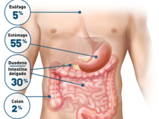 Imagen anatómica que indica la frecuencia con que se encuentran los tumores de estroma gastrointestinal (TEGI) en el aparato digestivo.