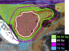 Imagen de la próstata y la zona cercana que muestra un plan de tratamiento con radioterapia corporal estereotáctica.