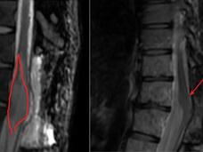 A before and after imaging scans showing a near complete response of a tumor in the spinal cord.