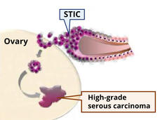 An illustration of STIC lesions (small purple bubbles) in the fallopian tubes, with several then traveling to an ovary, and finally forming a tumor in the ovary.