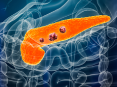 3D rendering illustation of the inside of a male body highlighting the pancreas and tumors.