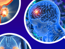 three partial circles containing brain tumor, breast tumor, and prostate tumor in imaging.