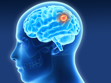 Head in profile with imaging of brain with a tumor in it. 