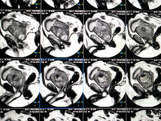 MRI image of an enlarged prostate.