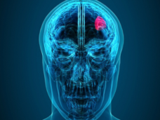 X-Ray scan of a human displaying a tumor in the brain.