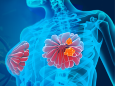 Torso imaging with breast cancer tumors.