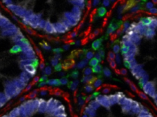 Multimodal image of cancer tumor cells shows how the Orion tool is able to combine two types of images—hematoxylin and eosin and immunofluorescence—in a single slide. 