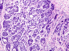 Image of a biopsy showing prostate cancer. Cancerous cells appear as solid sheets of purple, with irregular patterns and arrangements.