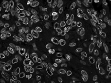 Example of nuclear wrinkling shows cells with oddly shaped nuclei. 