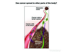 Illustration showing the spread of cancer from a tumor to other parts of the body, with labels showing cancer cells in the lymph system as well as cancer cells in a blood vessel. In the bottom part of the image, there is a large mass labeled "Primary cancer." Arrows indicate the movement of cancer cells from the primary site to the blood and lymphatic systems.