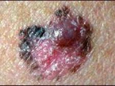 A close-up photo of melanoma on otherwise health skin. The area of the melanoma is black and mostly reddish-pink; a small mole-sized growth, purplish red, sit on top of the top right of the melanoma area.