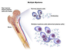 An illustration labeled “Multiple Myeloma” shows a cross section of a bone on the left. The top part of the bone, labeled “Red marrow where plasma cells are made”, links to two different groups of illustrations on the right. The top illustration labels normal plasma cells and antibodies, which have relatively equivalent amounts. The bottom illustration labels multiple myeloma cells (abnormal plasma cells), showing plasma cells that are larger and many more antibodies compared to the top illustration. 