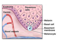 Illustration of a cross-section of skin, showing two main layers: the epidermis and dermis. The epidermis contains squamous cells, basal cells, and melanocytes. Melanin is visible around the melanocytes. The basement membrane separates the epidermis from the dermis. The dermis contains blood vessels.
