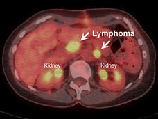 Medical scan showing lymphoma tumors (indicated by arrows) near the kidneys in a patient before treatment with ibrutinib.