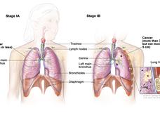 Illustration comparing Stage IA and Stage IB lung cancer. The left side shows Stage IA: A tumor 3 cm or less in the right lung, near the right main bronchus. Lymph nodes and anatomical features like the trachea, bronchioles, and diaphragm are labeled. The right side shows Stage IB: A tumor larger than 3 cm but not more than 5 cm in the left lung. Labels include the left main bronchus, carina, and more lymph nodes. An inset shows the lung lining, rib, and lung tissue, highlighting the tumor’s location.