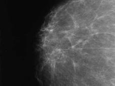 A mammogram image, in black white and grey. The image of the breast is mostly grey with some white highlights, increasing as it gets closer to the nipple.