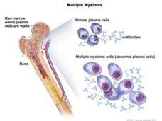 An illustration labeled “Multiple Myeloma” shows a cross section of a bone on the left. The top part of the bone, labeled “Red marrow where plasma cells are made”, links to two different groups of illustrations on the right. The top illustration labels normal plasma cells and antibodies, which have relatively equivalent amounts. The bottom illustration labels multiple myeloma cells (abnormal plasma cells), showing plasma cells that are larger and many more antibodies compared to the top illustration. 