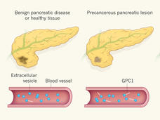 Three illustrations of the pancreas, ranging from benign diseases to precancerous lesion to pancreatic cancer. The cancer is shown as brown discoloration for the benign disease, growing to actual tumor cells on the right. Below each illustration, extracellular vesicles in the blood vessel gains more GPC1 as the pancreas gets more cancerous.
