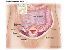 Illustration titled “Stage IIIA Ovarian Cancer” which focuses on the stomach, labeling the small intestine, colon, peritoneum, bladder, uterus, ovary, and fallopian tube. Cancer is also labeled and is present on the ovary, fallopian tube, bladder, and colon. A small inset box towards the top reads “Cancer cells in the peritoneum” showing a few yellow cancer cells. 