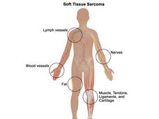 An illustration of the human body titled “Soft Tissue Sarcoma.” The body is in silhouette and has labels for various parts of the human body which are illustrated to mimic the look of each part. The labels read “Nerves”, “Muscle, Tendons, Ligaments and Cartilage”, “Fat”, “Blood Vessels”, and “Lymph Vessels.”