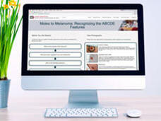 Desktop computer displaying a medical education website about "Moles to Melanoma: Recognizing the ABCDE Features" with interactive questions on the left and medical photographs on the right, shown next to a small potted plant.