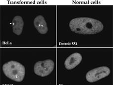 PNCs found in cancer cells (arrows) but not in normal cells.