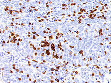 Histological image showing lesions in fallopian tube tissue, suggesting origins of high-grade serous ovarian cancer.