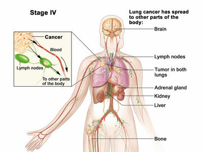 Illustration of Stage IV Lung Cancer. The image shows the human body with highlighted areas where lung cancer has spread, including the brain, lymph nodes, both lungs, adrenal gland, kidney, liver, and bone. An inset illustrates cancer cells spreading via blood and lymph nodes to other body parts. The diagram visually represents the extensive metastasis associated with Stage IV lung cancer.