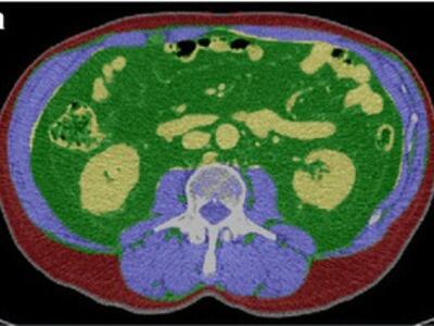 Axial CT images comparing two abdominal scans with color overlays showing skeletal muscle (purple), visceral fat (green), and subcutaneous fat (red).