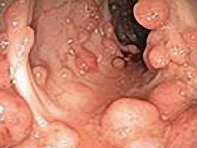 An endoscopic view of polyps. The polyps are of various sizes, mostly dome-shaped, around all sides of what appears to be a pink tunnel. 
