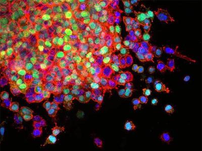 Lung cancer cells invade surrounding tissues and start to spread (metastasis).